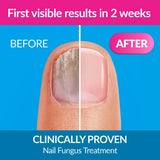 Excilor Nail Fungus Solution 30 ml